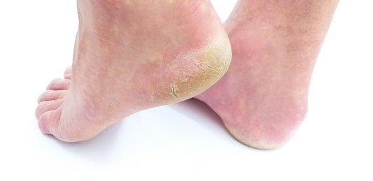 DIY Foot Creams for Cracked Feet