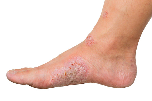 Can you Remove Calluses at Home