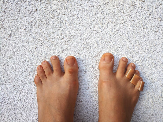 How Can You Treat Foot Corn Naturally?