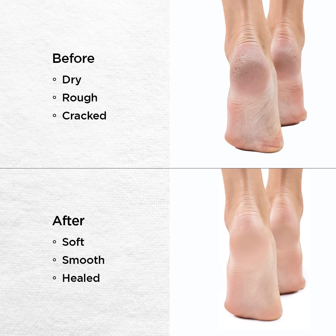 Foot Repair Cream - Cracked Heels - Callus Removal - Baby like Soft Fe –  Nourish & Flourish | Skin Care International